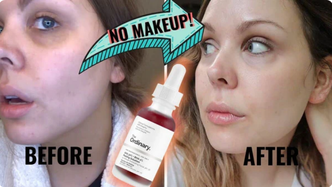 The Ordinary AHA 30% + BHA 2% Peeling Solution – 30ml
