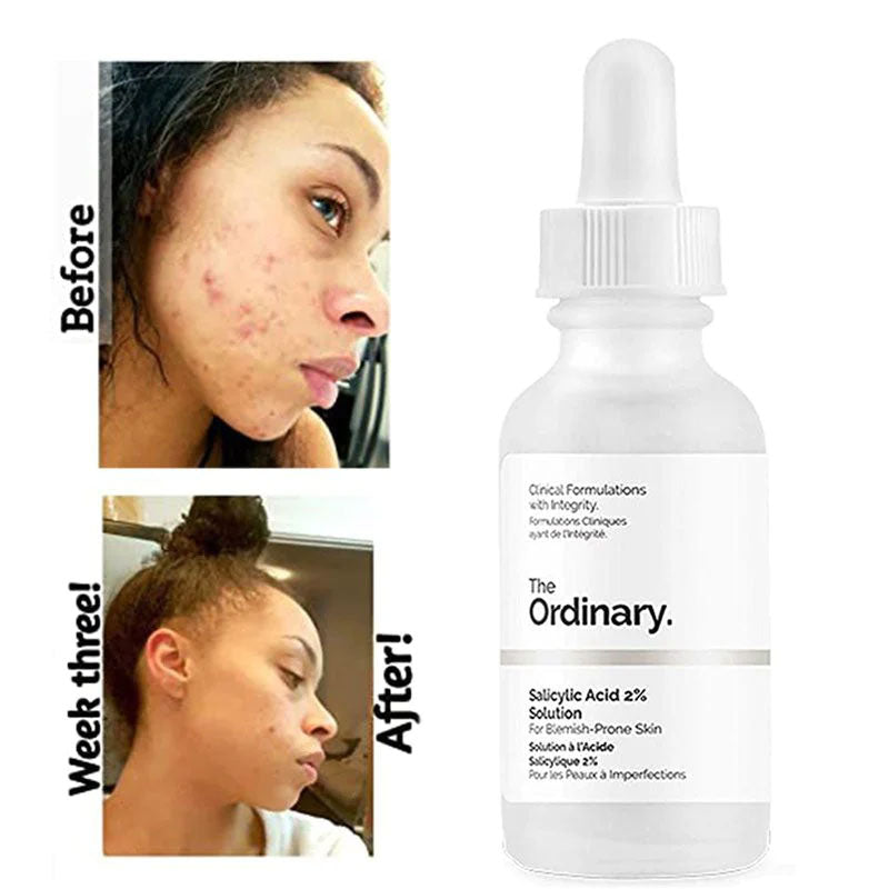 The Ordinary Salicylic Acid 2% Solution – 30ml